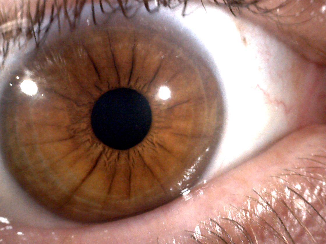 Macro photograph of a brown right iris showing the pupil, the jagged collarette, dark radial furrows and the conjunctival vessels on the white of the eye.